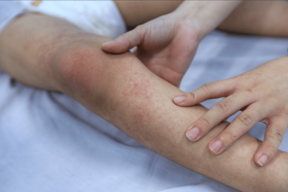 Ban đỏ, xuất huyết dưới da là triệu chứng điển hình