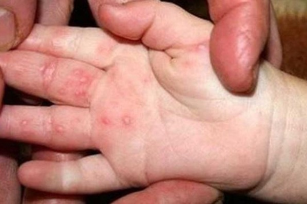 Gia tăng ca sốt xuất huyết và tay chân miệng chuyển nặng tại nhiều địa phương, Bộ Y tế cảnh báo người dân không được chủ quan.