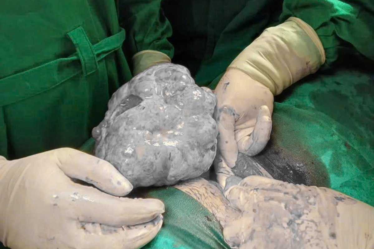 Khối u với kích thước khủng được các bác sĩ đưa ra khỏi cơ thể