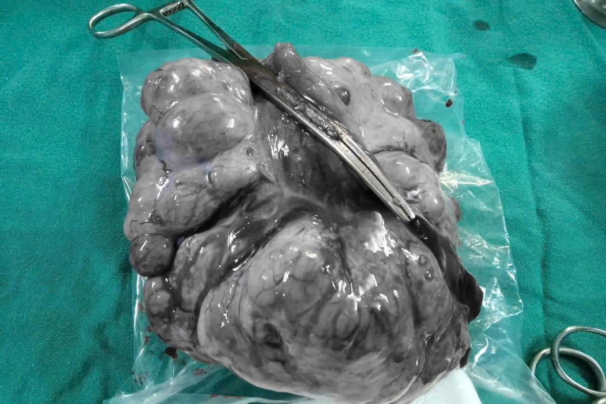 Cận cảnh khối u có kích thước siêu lớn