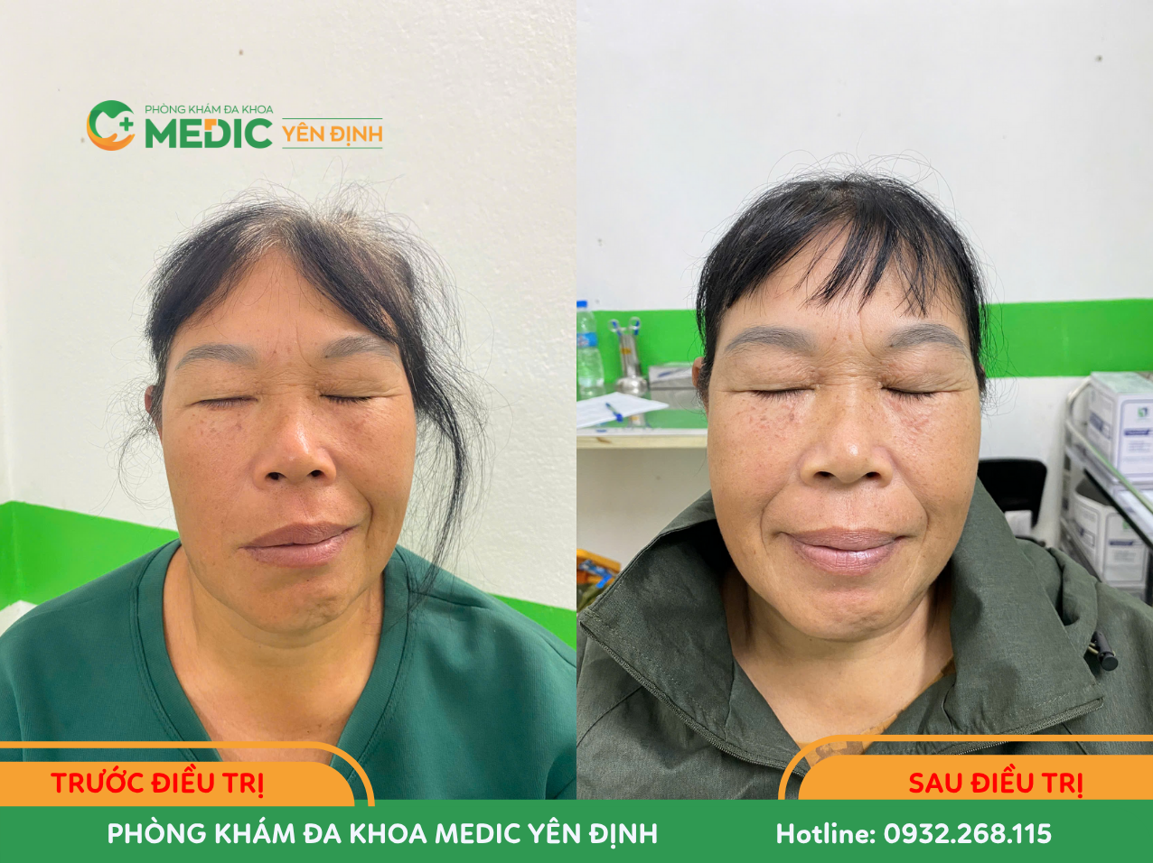 Tại Hệ thống Y tế Medic đã điều trị thành công cho nhiều bệnh nhân bị liệt dây thần kinh số VII