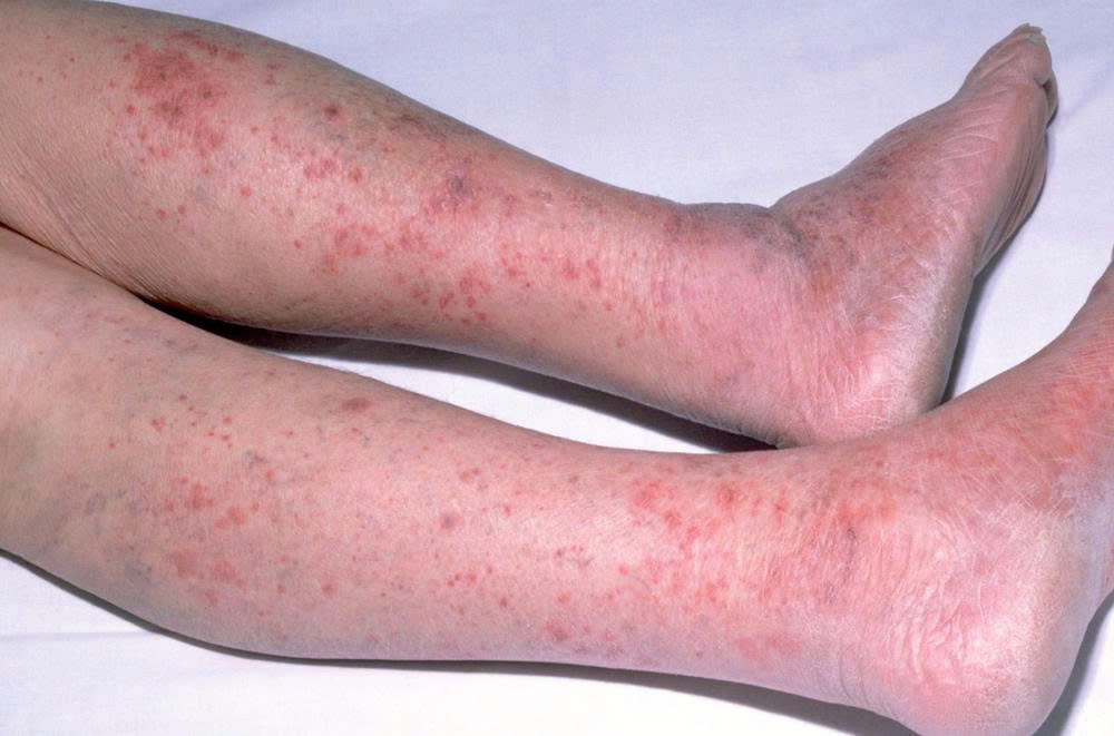 Dấu hiệu bệnh viêm màng não mô cầu