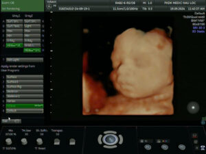 Hình ảnh siêu âm thai 4D thời kỳ 30-32 tuần