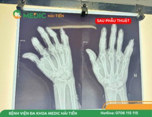 Ngón tay đã được làm thẳng, khớp và xương trở về đúng trục giải phẫu.