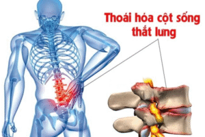 Thoái hóa đốt sống lưng hiện là một trong những bệnh lý khá phổ biến