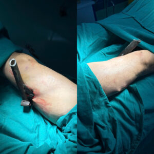 Chân chống xe máy xuyên qua đùi phải của bệnh nhân sau tai nạn giao thông.