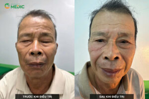 Kết quả trước và sau điều trị của bệnh nhân tại khoa YHCT - PHCN Bệnh viện Đa khoa Medic Hải Tiến