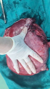 Cận cảnh khối u khủng được lấy ra khỏi cơ thể