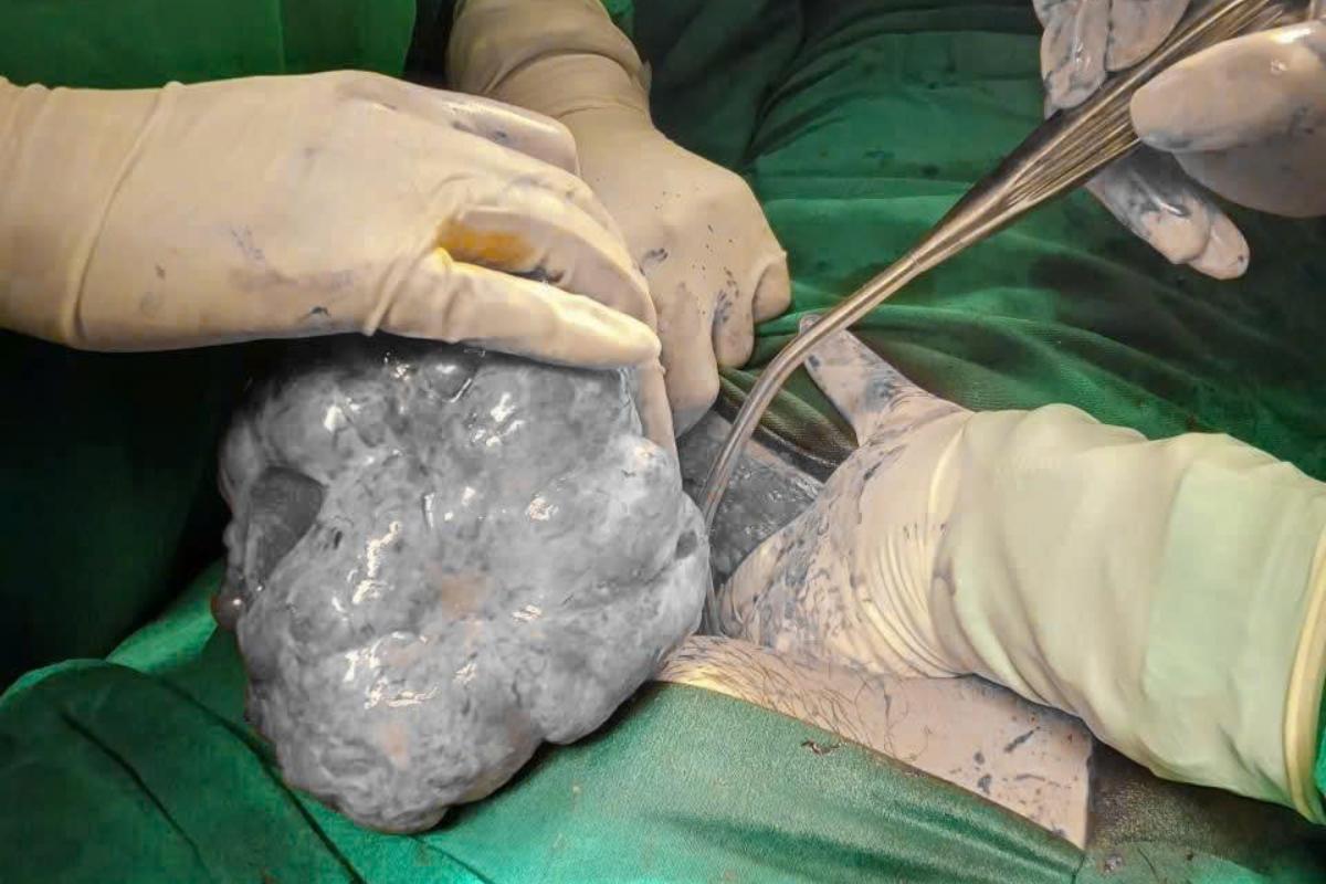 Cận cảnh khối u buồng trứng được đưa ra khỏi cơ thể 