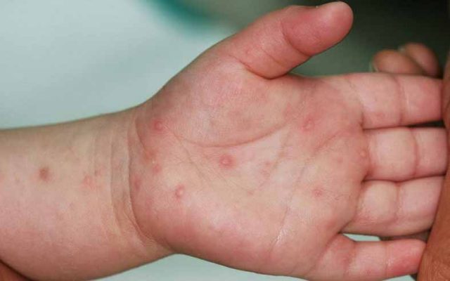 Bệnh tay chân miệng là bệnh truyền nhiễm do siêu virus gây ra ở trẻ em