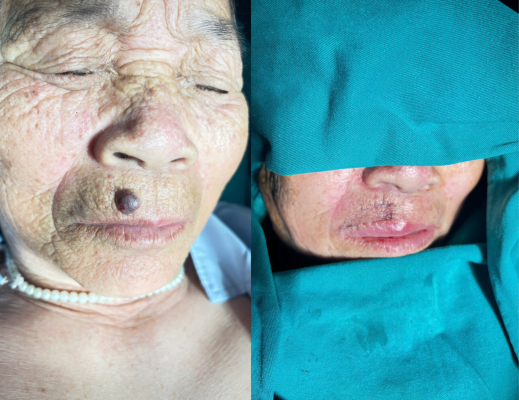 Trước và sau khi thực hiện phẫu thuật chuyển vạt tại Khoa Ngoại Bệnh viện Đa khoa Medic Hải Tiến