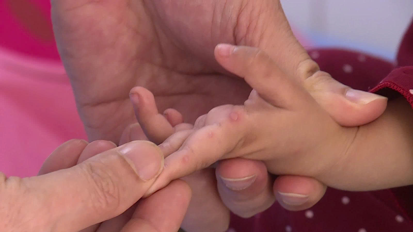 Biểu hiện của bệnh nhi bị mắc tay chân miệng.